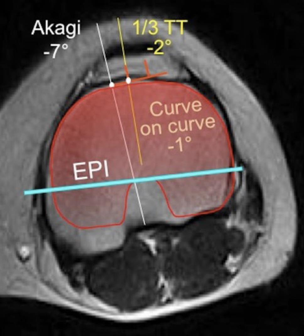 TIBIAKOMPONENTIN ROTAATION MAAMERKKEJÄ Akagi line = connecting the tibial insertion