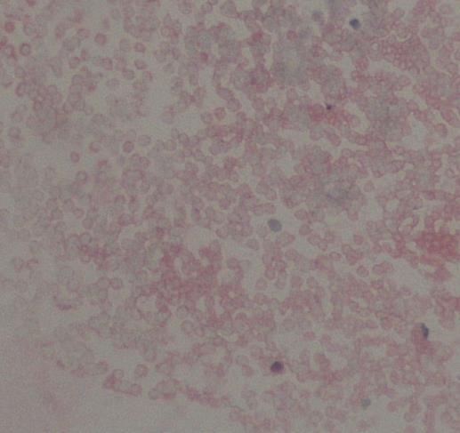 31 Kuva 20. Runsaasti punasoluja X200 2.6.2 HPV Ihmisen papilloomavirus eli human papilloma virus (HPV) tarttuu sukupuoliteitse ja on erittäin yleinen. Itämisaika voi olla kuukausia tai jopa vuosia.