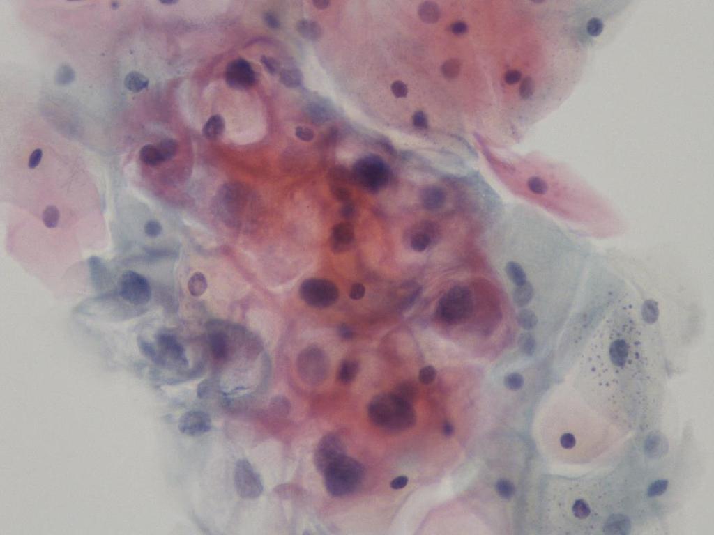 33 Kuva 22. Koilosyytteja X500 HPV-diagnostiikkaan kuuluu myös PCR eli nukleiinihappomonistus. Näin saadaan virus tyypitettyä suuren ja pienen riskin tyyppeihin.