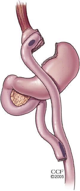 32 Review of literature metabolic and nutritional status should be carried out regularly (Fried et al., 2013). Bone mineral density decreases after bariatric surgery (Rodriquez-Carmona et al.
