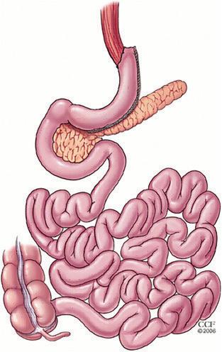 A: Roux-en-Y gastric bypass (RYGB): the stomach is separated into two compartments, leaving only the small upper chamber in the digestive continuity.
