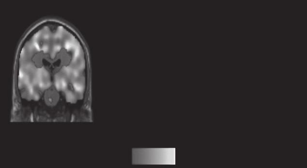 60 Results between insulin-stimulated BGU and follow-up BMI or HbA1c at the 2 or 3-year follow-up. A 1.6 4 C r=0.56 p=0.02 30-1 (μmol 100g min ) Brain glucose uptake r=0.60 p=0.006 25 20.. -1.