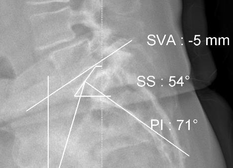 kasvaa SVA n kasvaessa pelvic tilt lisääntyy, maksimi PI:n verran