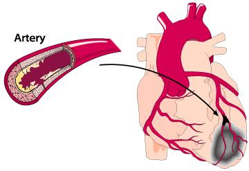 Mikä on akuutti sydäntapahtuma? 3 Sepelvaltimot kuljettavat sydämeen verta ja sen mukana happea ja ravinteita.