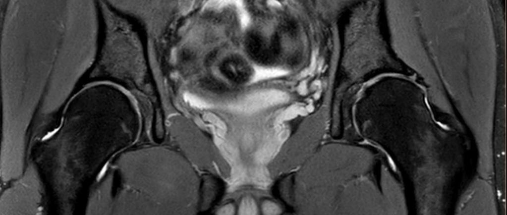 Ongelmanratkaisua MRI: retroversio.