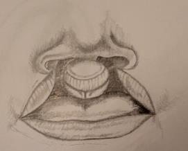 3 Suulaenhalkiot Suulakihalkiot voivat sijaita joko pelkästään pehmeän suualen alueella tai ulottua kovan suulaen puolelle (kuva 5) aina foramen incisivumiin saakka, hammaskaaren takaosaan.