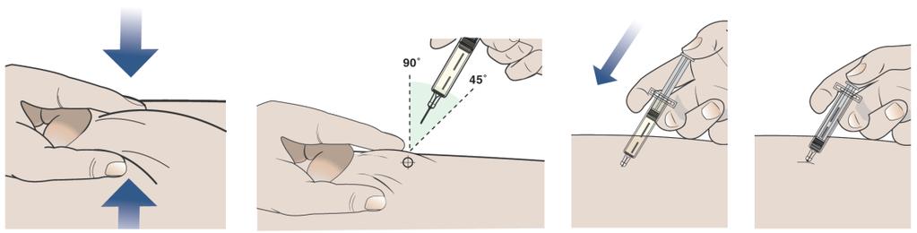 b) Pistä seuraavien neljän vaiheen mukaan. 1. Purista vähintään 2,5 cm puhdistamaasi ihoa hellävaraisesti sormiesi väliin. 2. Työnnä neula sormiesi välissä olevaan ihopoimuun 45 90 asteen kulmassa. 3.