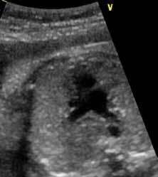 Aortankaaren loppuosan poikkileikkaus on alimpana (AoD), ja heti sen yläpuolella on pienempi henkitorven poikkileikkaus (T).