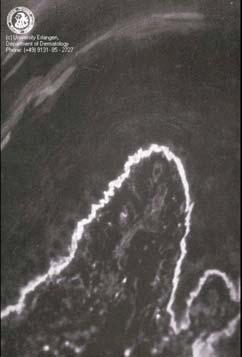 Bcl-2, decreases BCR signal Deleted BCR