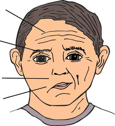 24 nen raajahalvaus, suupielen roikkuminen, puheen häiriöt (afasia ja dysartia), tunnon heikentyminen toispuolisesti, näön hämärtyminen tai sokeus, huimaus, pahoinvointi, oksentelu, kaksoiskuvat sekä