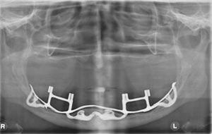 7 Kuva 2B. Subperiosteaalinen implanttirakenne.