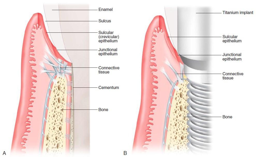 10 Kuva 3. Hammasta (A) ja implanttia (B) ympäröivät rakenteet. (Rose LF, Mealey BL, Periodontics: medicine, surgery, and implants, St. Louis, 20
