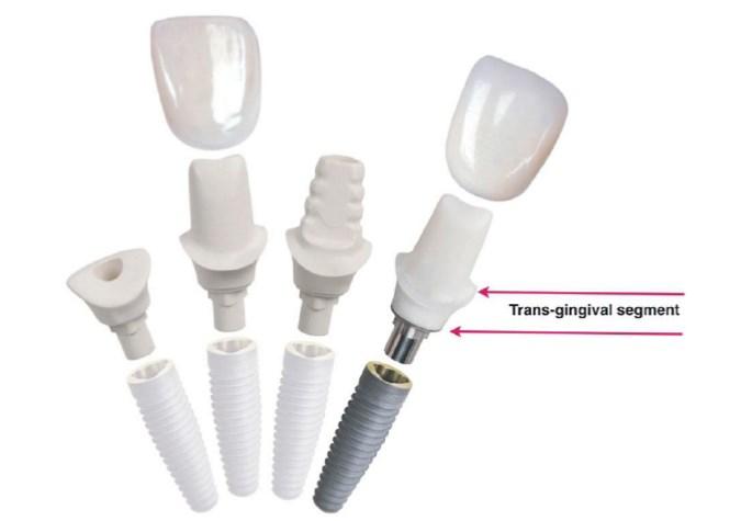 17 Kuva 5C. Transgingivaalinen osa. (Shafie 2014) Glidewell Laboratories 2013. 4.