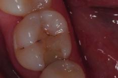 Increasing the longevity of restorations by minimal intervention) hoitohistoria Korjaamisen edut hammaskudoksen säilyttäminen