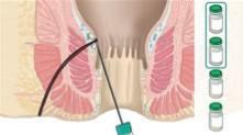 2. Työnnä neula ulkoiseen aukkoon ja ruiskuta kahden jäljellä olevan injektiopullon sisältö kudosseinämään fistelikanavien suuntaisesti useina pieninä annoksina.