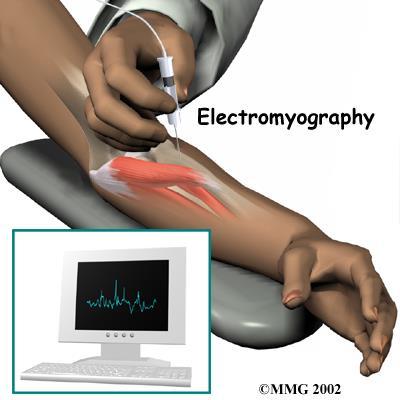 Elektromyografia (EMG): neulan näkemää - Patologinen spontaanitoiminta: tuoreen tai melko tuoreen denervaation merkki.