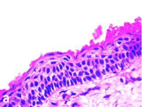 10 a) Keratokystan tyypillinen histologinen näkymä, jossa on kanttinauhamaista, ohutta ja yhtenäistä kerrostunutta levyepiteeliä. Epiteelin paksuus on neljästä kahdeksaan solua.