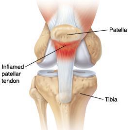 18 Patella eli polvilumpio Polvijänteen tulehdus Tibia eli sääriluu KUVA 7. Hyppääjän polvi (Bongers 2017) 5.