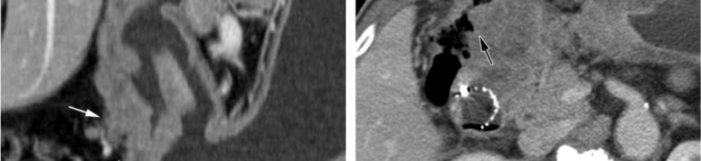 ulcerative mass without perigastric extension, in the lower body.