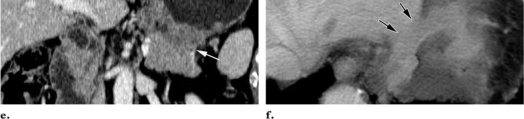 The tumor represents an advanced cancer of the antrum and is accompanied by obliteration