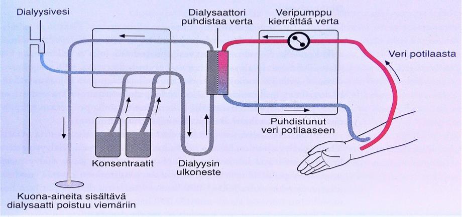 9 Kuva 2. Hemodialyysin periaate (Kylmäaho & Mukka 2008, 83). Vatsakalvodialyysi eli peritoneaalidialyysi on tavallisin kotidialyysimuoto.