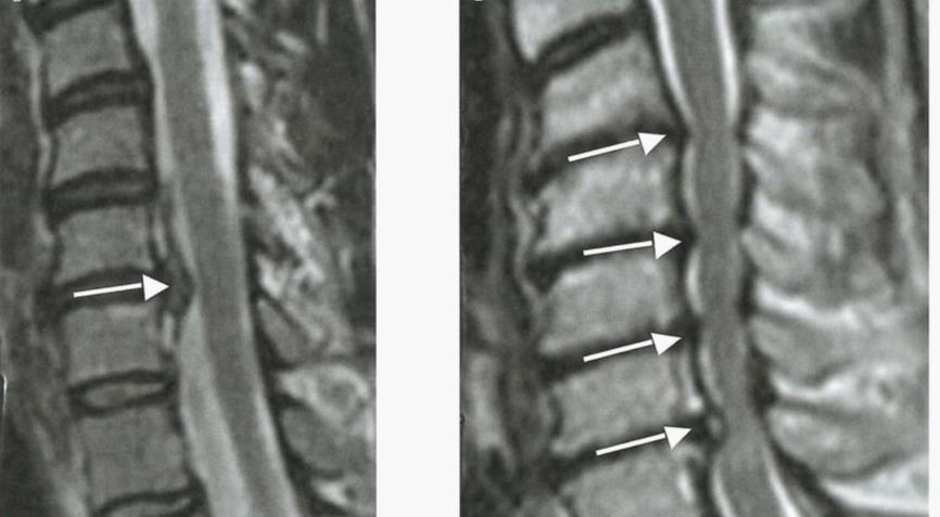 29 yllämainittuja oireita. Diagnoosin tekeminen voi kuitenkin olla vaikeaa, koska tällaiset neurologiset vauriot eivät aiheuta oireita helposti tunnistettavalla ja samanlaisella tavalla.