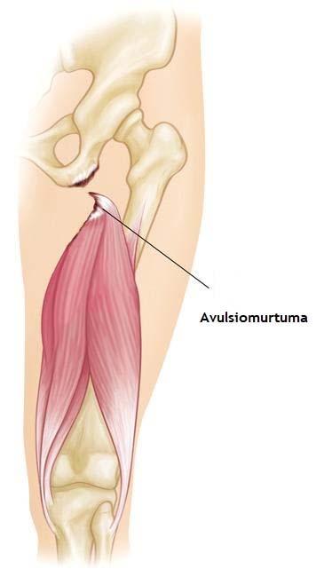 Oireita: suoliluunharjun paineluarkuus, turvotus kipualueella ja kipua yskiessä tai niistäessä. Tuberositas ischiin avulsiomurtuma Kipua takareiden kiinnityskohdassa, istuinkyhmyssä.