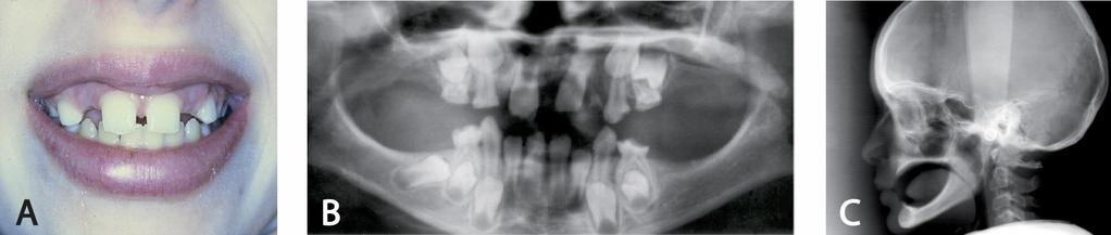 Hampaiden puutokset Hampaiden synnynnäiset puutokset jaotellaan puuttuvien hampaiden lukumäärän mukaan hypodontiaan, oligodontiaan ja anodonatiaan (Kuva 3).
