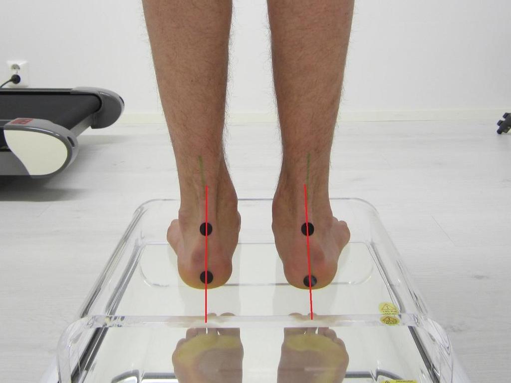 48 Kuva 10. Kantaluiden eversio. Painon jakautumista peilipöydällä tarkasteltaessa jalkaterien etuosissa paino jakautuu voimakkaasti isovarpaiden alle ja vain hyvin vähän ulkosyrjille.