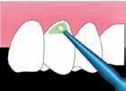Preparoidun hampaan suojaus yliherkkyyttä vastaan (suora tekniikka) 1 2 3 4 *