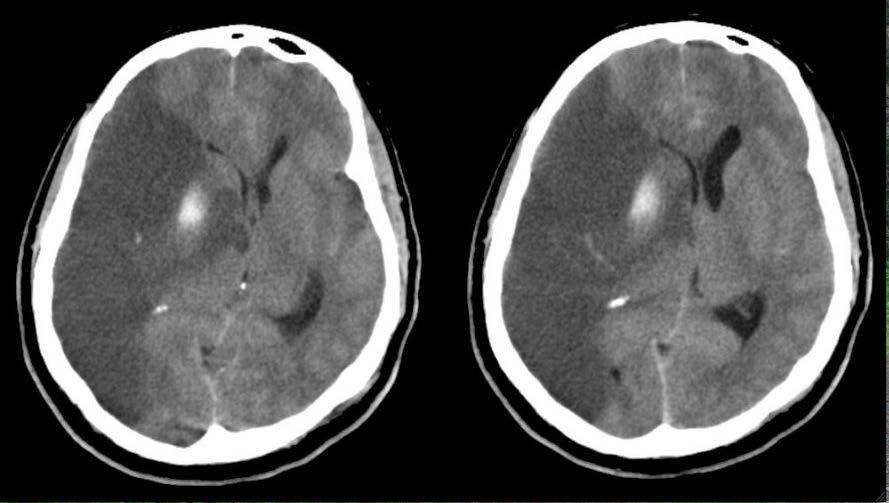 tutia oireen alusta) Aspiraation esto, aivopaineen -, verenpaineen, hyperglykemian -, kuumeen hoito, (hypotermia)