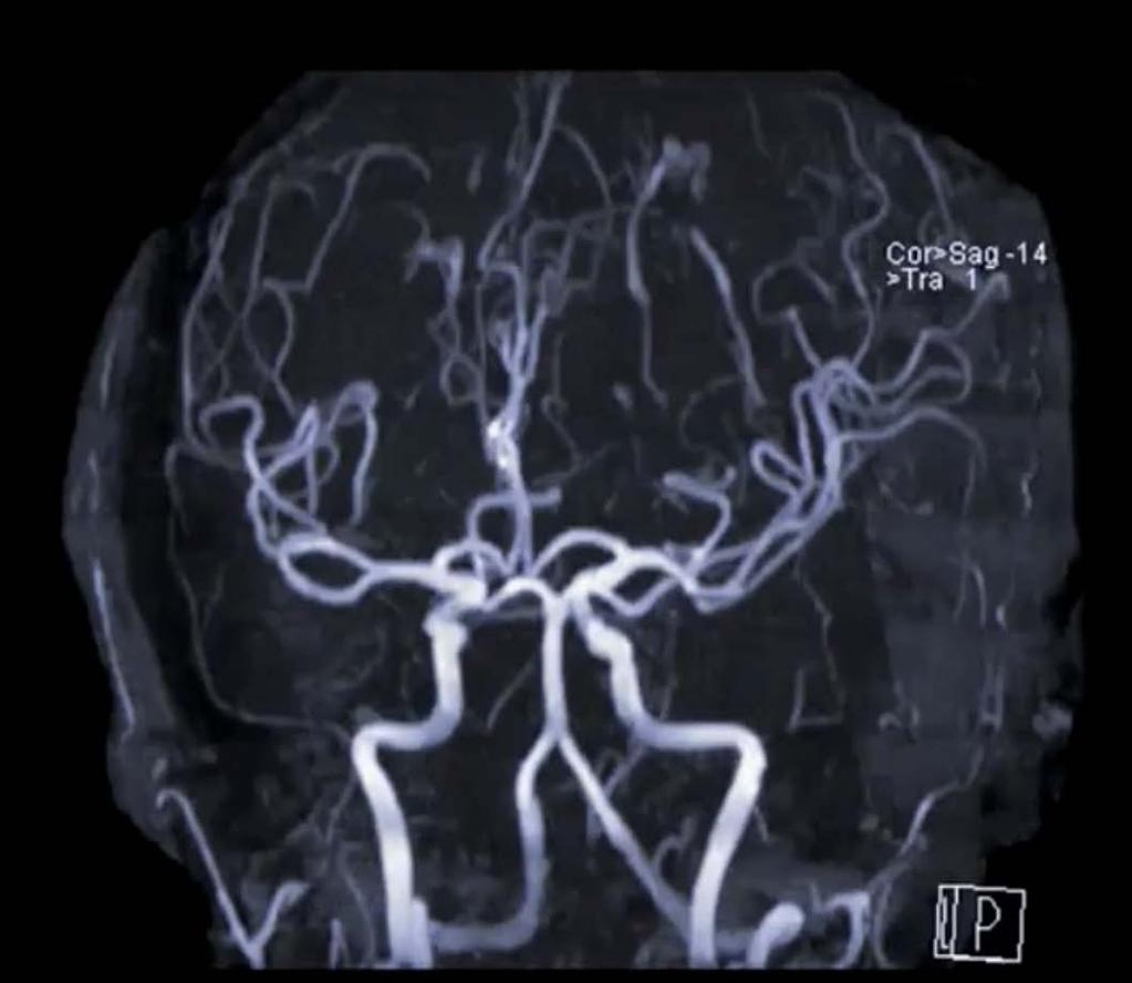 MK-angiografia a. cerebri anterior a. cerebri media a.