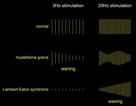 Toistostimulaatio Normaali Myastenia Gravis 3 Hz stimulaatio Vaste on on stabiili 20 Hz stimulaatio Annettaessa motoriseen hermoon ärsykettä vaste yleensä pysyy stabiilina (normaali) Myasteniassa