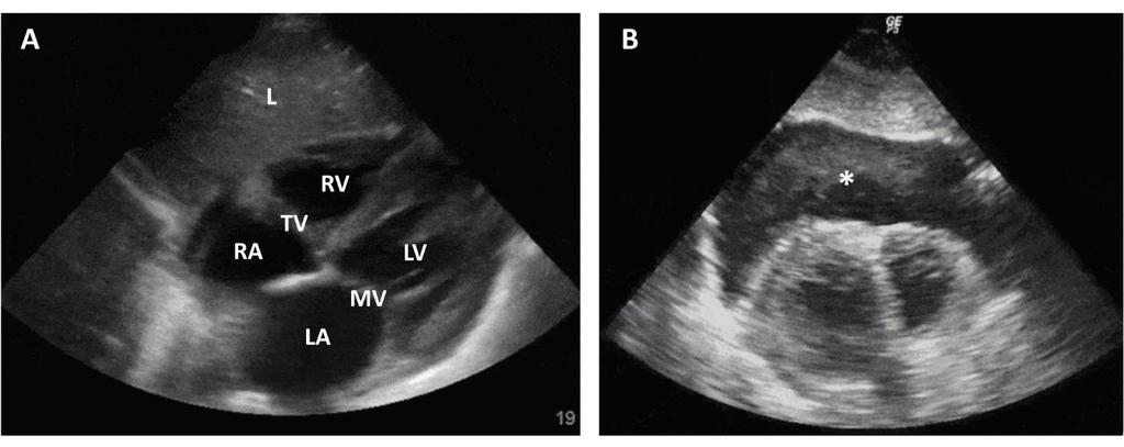 A) Sydänpussinäkymä, jossa nähdään sydämen neljä lokeroa. RV = oikea kammio, RA = oikea eteinen, LV = vasen kammio, LA = vasen eteinen, TV = trikuspidaaliläppä, MV = mitraaliläppä, L = maksa.