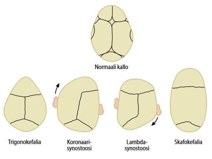 2.2 Sikiöaikana kehittyvät kallon muotovirheet 9 Vauvan pään muodon vaihtelu on normaalia.