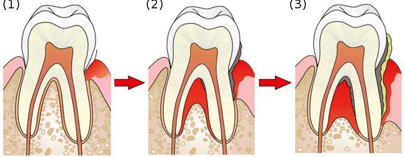 10 Parodontiitin eteneminen ja ientaskun muodostuminen. 1) Ien on tulehtunut, jonka vuoksi ikenen väri on muuttunut vaaleanpunaisesta punoittavaksi. Tulehtunut ien on aristava.