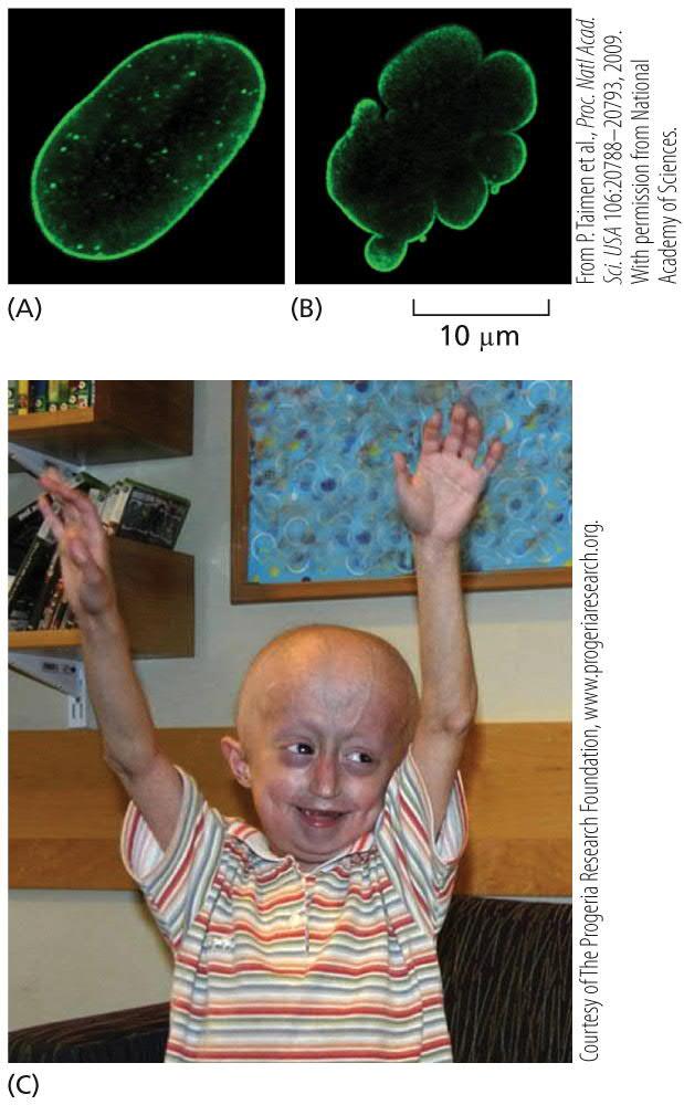 Progeria Copyright 2019 W. W. Norton & Company (A) In a normal cell, the protein lamin A (green) is assembled into a uniform nuclear lamina inside the nuclear envelope.