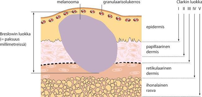 4 2.3 Melanooman histologinen luokittelu Melanoomien kliinisen diagnoosin tärkein työkalu on poistetun epäillyn melanooman histopatologinen tutkiminen.