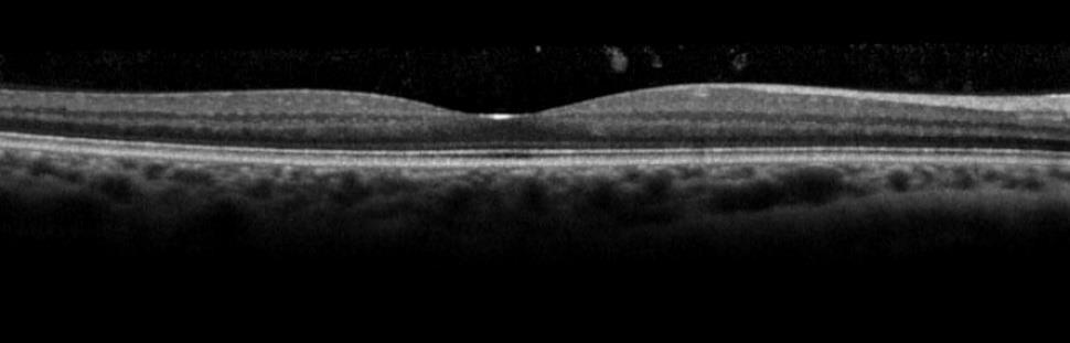 10(51) 2 SILMÄNPOHJAN IKÄRAPPEUMA Silmänpohjan ikärappeuma (age-related macular degeneration, AMD) on silmänpohjan tarkannäkemisen alueen rappeuma sairaus.