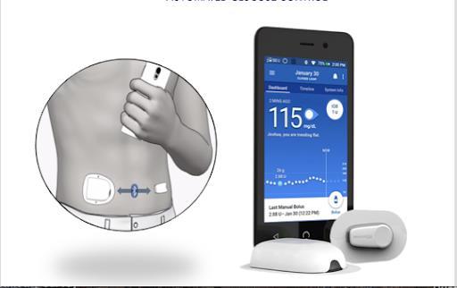 T1D HOIDON KEHITTYMINEN - PUMPUT Insuliinipumpulla voitu taklata jos insuliinin tarve kovin erilainen eri päivinä tai eri aikaan päivästä Helppo insuliinin annostelu nappia