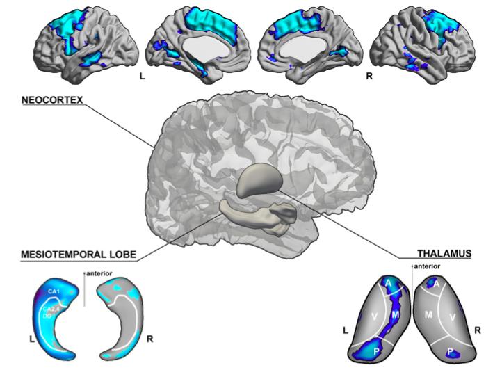 SCHEMATIC ILLUSTRATION OF GRAY MATTER STRUCTURAL ANOMALIES IN TEMPORAL