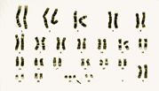 Harvinaiset kromosomipoikkeavuudet 30 Jotkin perimän poikkeavuudet eli mutaatiot ovat niin pieniä, että ne vaikuttavat ainoastaan yhteen geeniin.