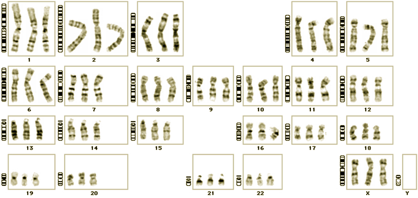 Kun muutos perimässä on niin suuri, että se näkyy katseltaessa kromosomeja valomikroskoopilla, on kyseessä kromosomipoikkeavuus.