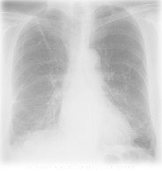 Asbestin terveysvaikutukset Asbestipöly altistaa monille sairauksille mm: asbestoosille keuhkosyövälle kurkunpääsyövälle ruuansulatuskanavien syöpiin Asbestialtistumisesta sairauden ilmenemiseen on