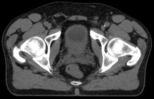 (HU>>0) CT Meidän haaste; Miten voitaisiin lisätä pseudo-ct:n heterogeenisuutta?