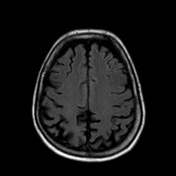 Posteriorinen kortikaalinen atrofia Alzheimerin