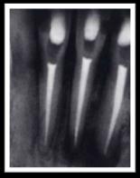 Juurikanavassa Ultraäänikärjellä tehdään tilaa katkeneen instrumentin ympäriltä poistamalla dentiiniä Nesteen vaikutuksesta puru irtoaa helposti eikä instrumentti pääse kuumenemaan Arens et al 2009