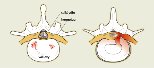 syynä on tavallisimmin välilevy (noin 40-55 %) Fasettiniveltä (kahden peräkkäisen selkänikaman nivelhaarakkeiden välinen