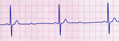 Johtumishäiriöt ja -katkokset Muutos Osat/tyyppi EKG-muutokset Kuva AV-blokit I aste - PR-aika yli 0,2 sekuntia II aste: Mobitz I = Wenckebach II aste: Mobitz II III aste - Jokainen peräkkäinen