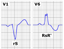 ) ei pääse läpi - EKG:ssa PR-intervalli pitenee jatkuvasti kunnes yhtäkkiä näkyy P-aalto jota ei seuraa QRS-kompleksi. Tämä sekvenssi toistaa itseään.